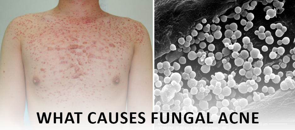 what causes fungal acne