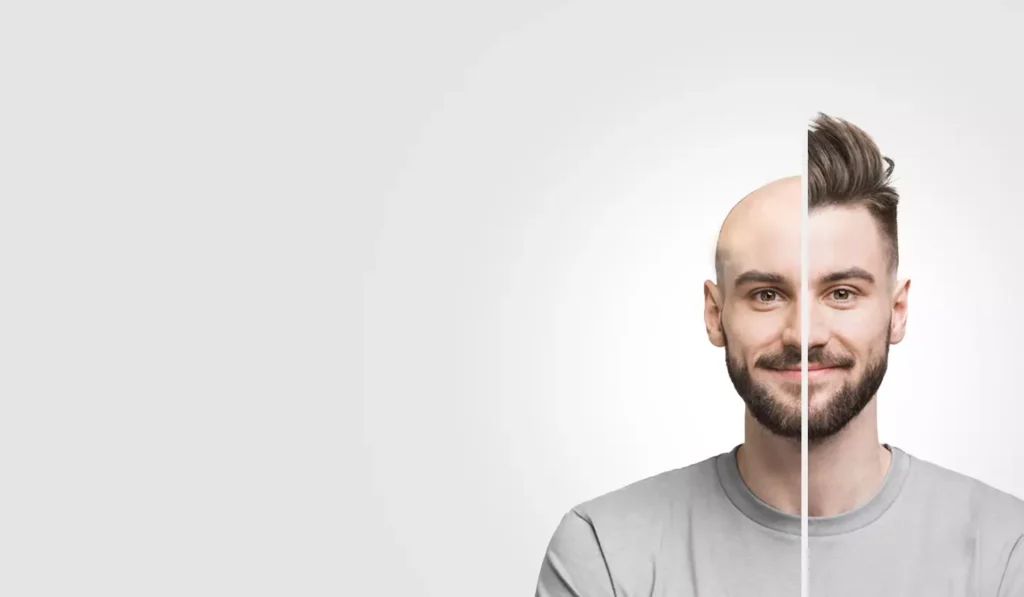 Hair Transplant